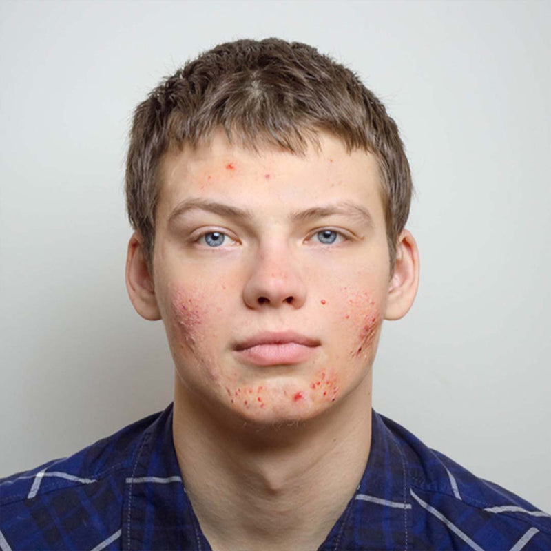 The "Double-Duty" Routine: How to Treat Adult Acne and Fine Lines at the Same Time