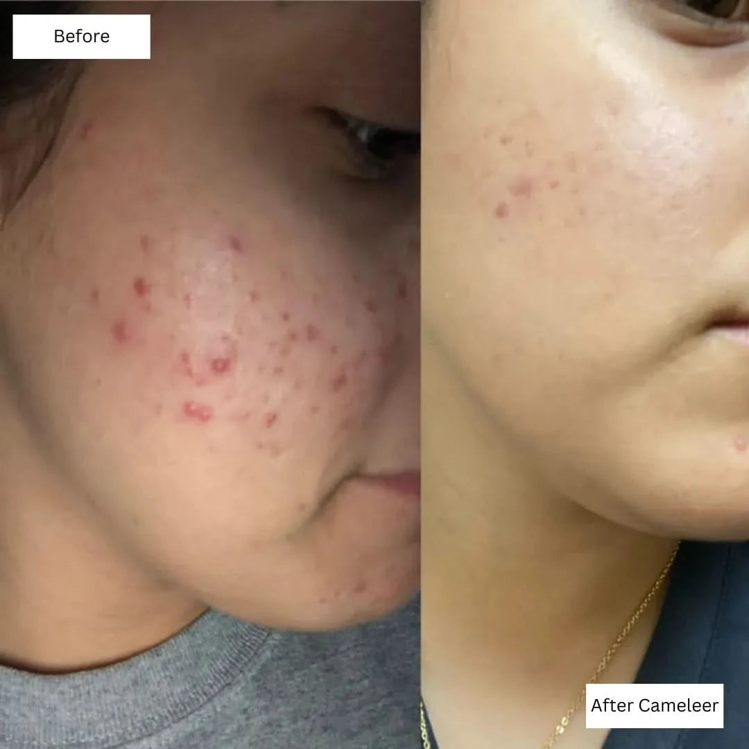 Repair, Revive & Rejuvenate Your Skin With Cameleer Face Mask - Dityana™ Skincare